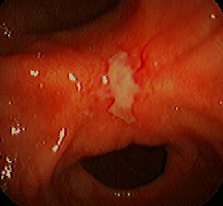 Ein Geschwür kann mittels Gastroskopie erkannt werden