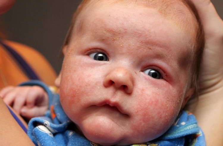 Cómo se manifiesta la alergia a los gatos en niños