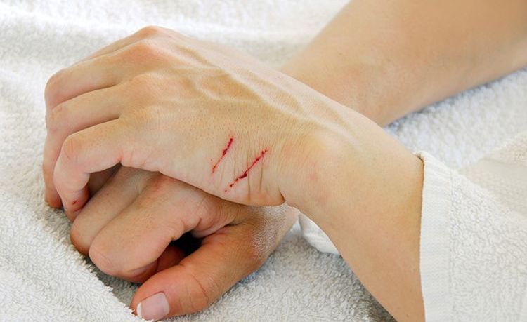 Felinosis