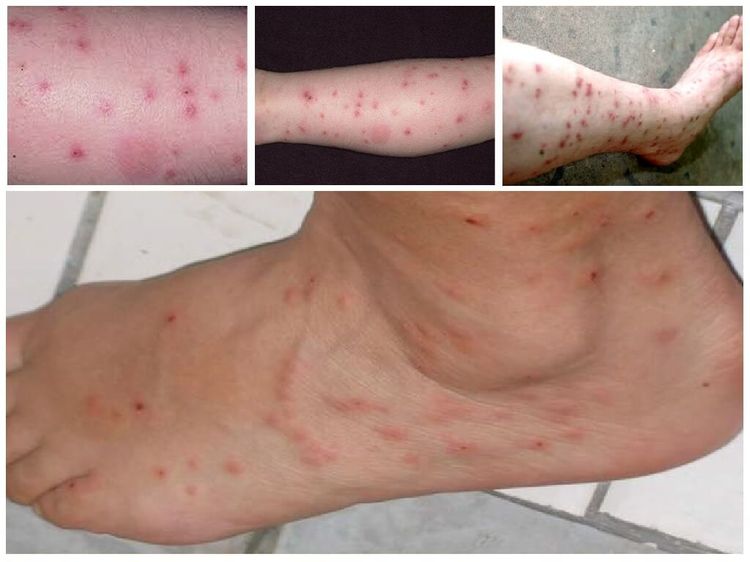 Picaduras de pulgas en las piernas de una persona