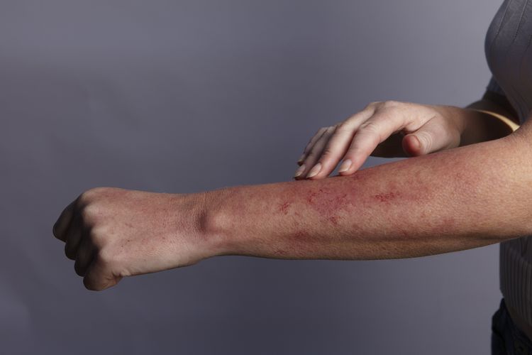 Síntomas de la alergia al gato