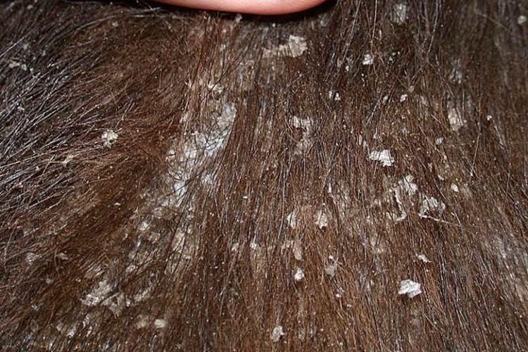 Síntomas de la queiletielosis