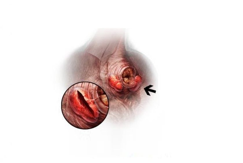 Fístula debajo de la cola