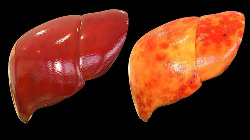Hepatosis hepática