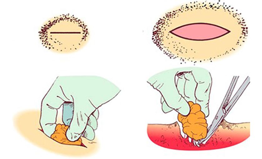 Esquema de extirpación del lipoma